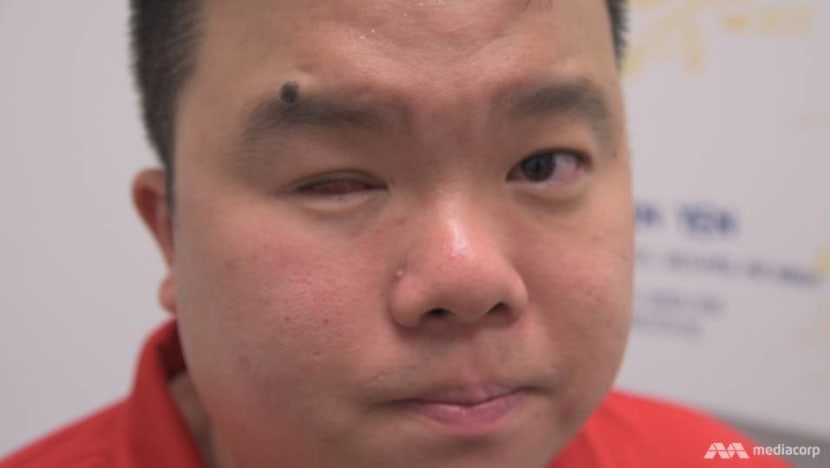 Jason Chee, medal-winning para-athlete, loses right eye to cancer