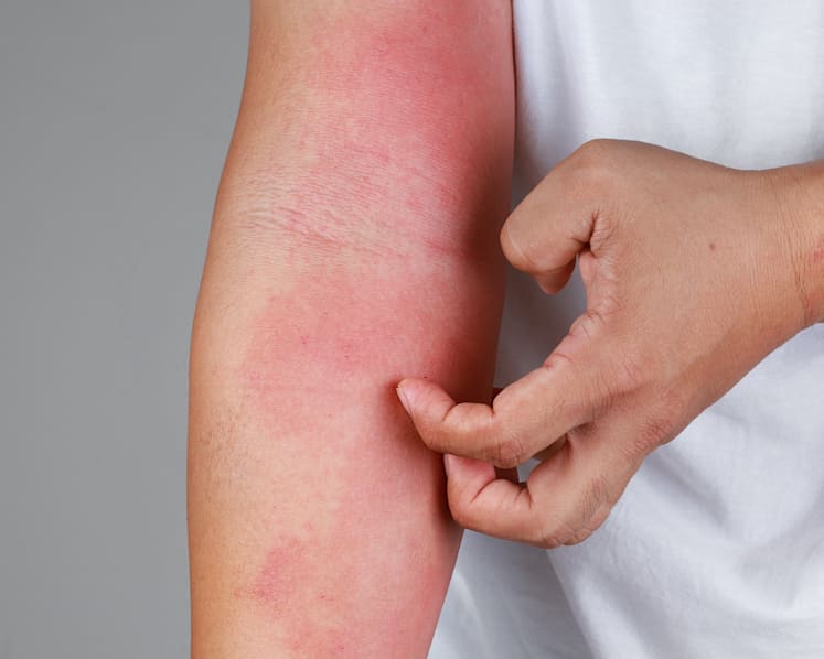 Patient given immunosuppressant for rash hospitalised for serious side effects; doctor suspended