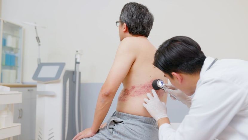 MOH to extend subsidies, MediSave usage for shingles vaccine Shingrix MOH to extend subsidies, MediSave usage for shingles vaccine Shingrix
