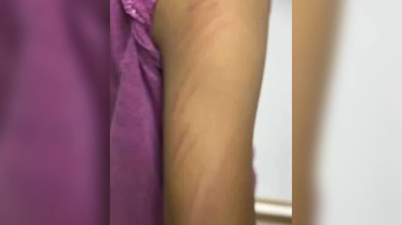 疑遭师竹棍抽打 泰国八岁女童留十多处瘀伤