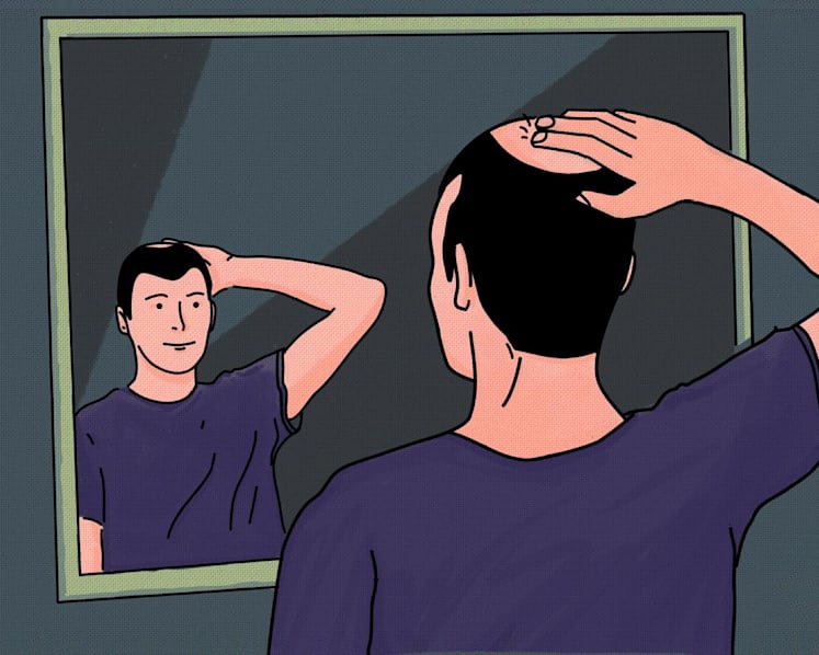 Gen Y Speaks: What early onset balding taught me about life, loss and what it means to be a man