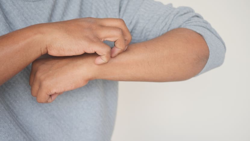 Beat the itch: How advanced therapies are transforming eczema treatment Beat the itch: How advanced therapies are transforming eczema treatment