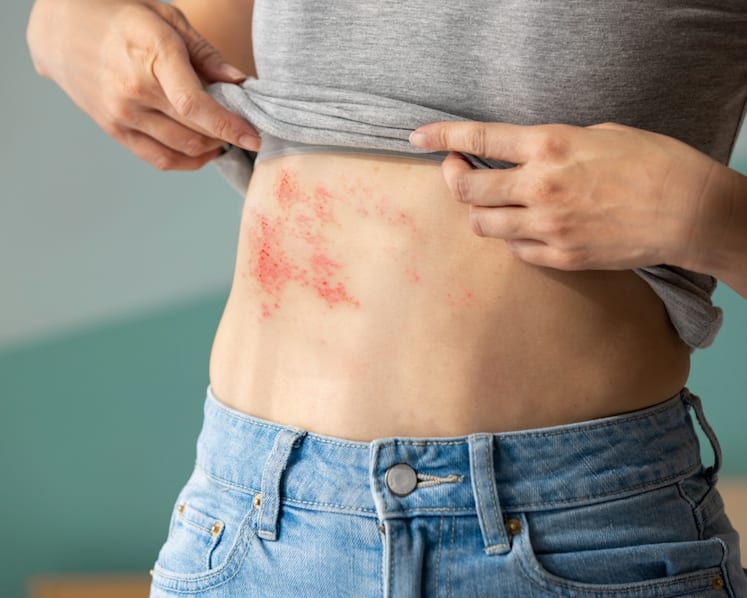 Why shingles hits harder with diabetes