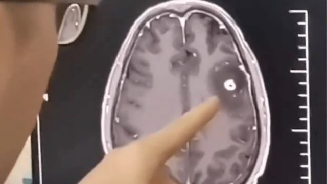 六旬男爱喝生猪血补身 晕倒送院查发现脑内爬满寄生虫