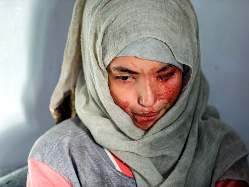 Ms Al-Anoud Hussain Sheryan, a 19-year-old girl disfigured in an acid attack by her abusive husband, sits at a hospital where she is undergoing treatment in Yemen's capital Sanaa on Jan 28, 2021.