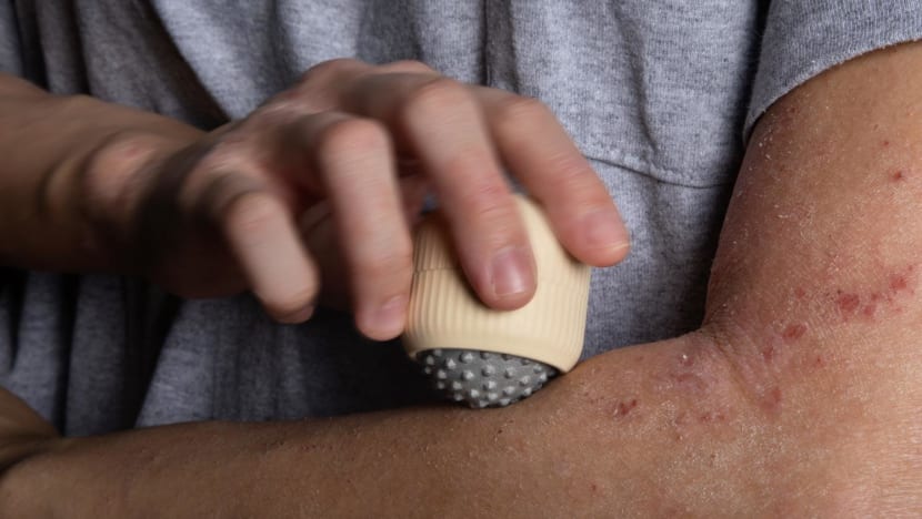 Invention to relieve eczema itching runner-up in James Dyson Award; winning entry helps stroke sufferers