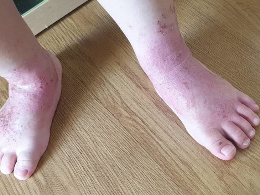 Infant eczema: Genes play a role but symptoms can be controlled, doctors say