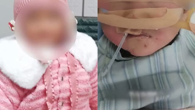 误食强酸清洁粉  河南两岁女童口腔食道严重灼伤失声