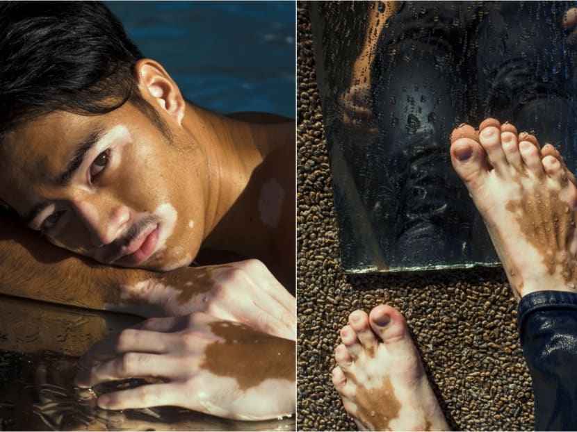 Most people who live with vitiligo, a skin pigmentation disorder, are usually physically well and do not feel any discomfort on their skin.