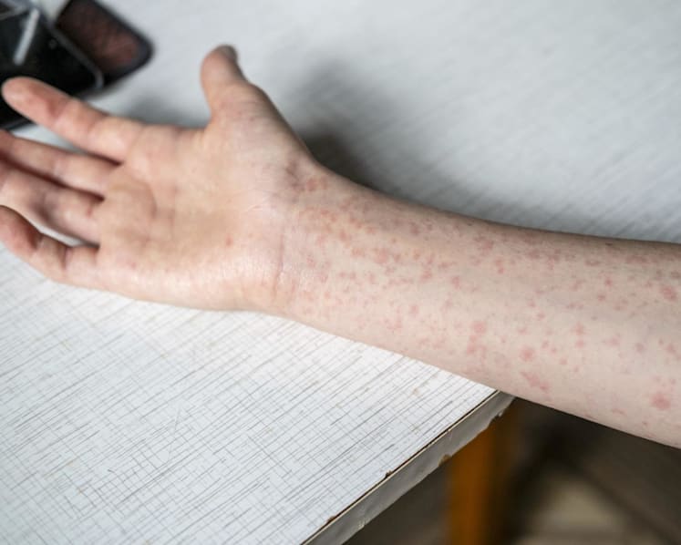 Singapore's measles cases reach six-year high, three vaccinated cases among 40 infections Singapore's measles cases reach six-year high, three vaccinated cases among 40 infections