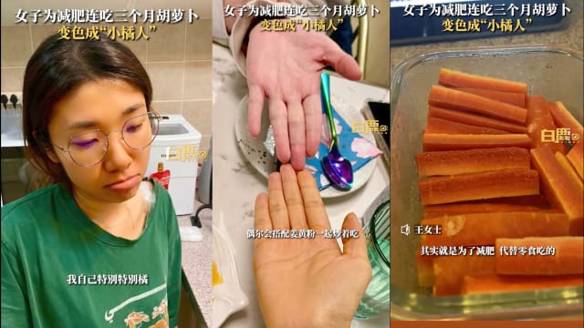 减肥连吃三个月胡萝卜 中国女子变“小橘人”