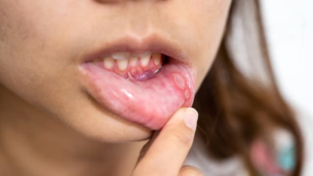 反复嘴破以为上火 中国女子一查竟发现患癌