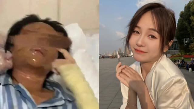 湖南女主播 遭“快递炸弹”炸伤毁容