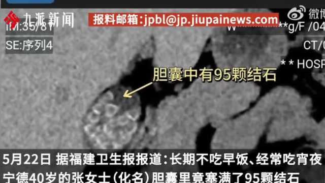 女子上十年晚班生活不规律 胆囊长出近百颗结石