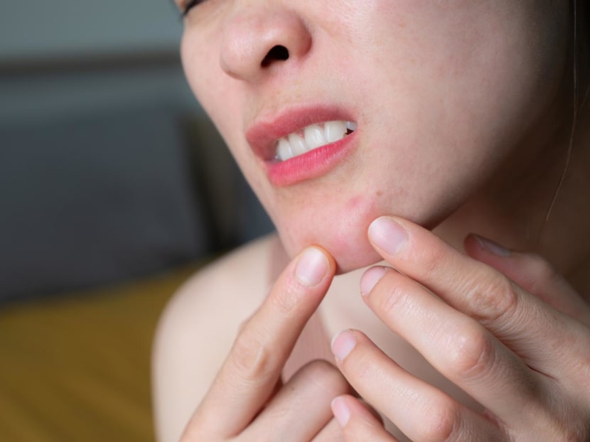 What is hormonal acne and why do some women battle it into adulthood? What is hormonal acne and why do some women battle it into adulthood?