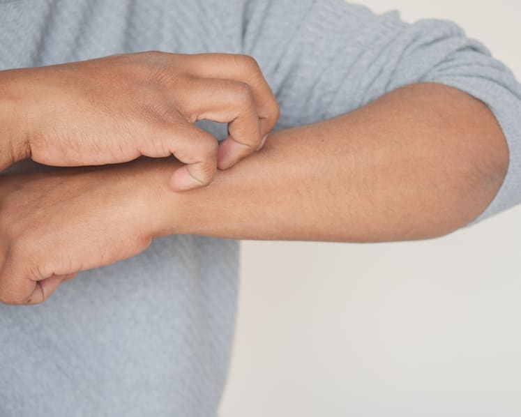 Beat the itch: How advanced therapies are transforming eczema treatment