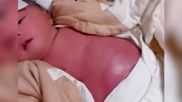 婴儿烧到全身通红家中仅剩一退热贴 网民：赶紧送医院