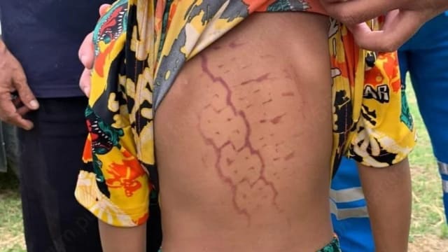 被皮卡车碾过幸存 泰男童背后烙下车轮印