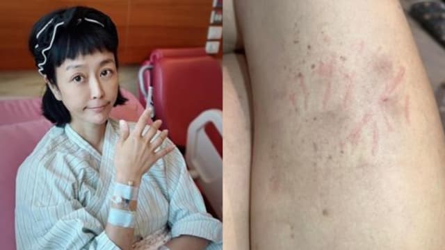 才割掉卵巢子宫　唐玲大腿出现骇人血痕