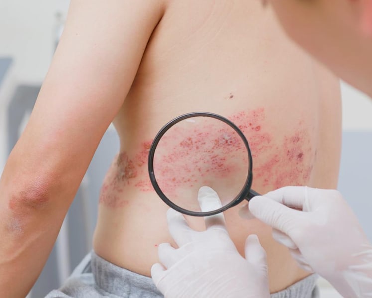 Shingles vaccine linked to fewer heart attacks and strokes, study suggests – what you need to know
