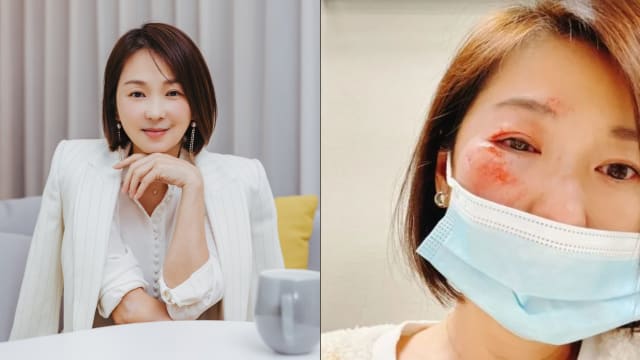 《家和万事兴》六月受伤　脸破相渗血、眼睛红肿！