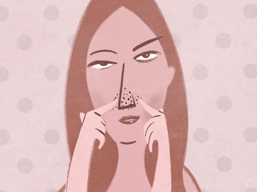 How to get rid of pesky blackheads and whiteheads without scarring your skin