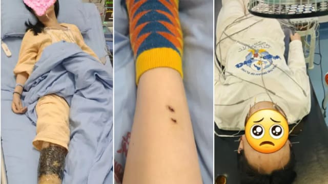 被银环蛇咬两年仍有后遗症 中国女子揭惊魂记