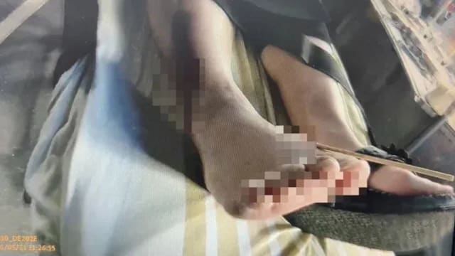 台湾女子穿夹脚拖逛夜市 不慎踩中竹签脚部遭刺穿
