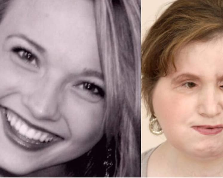 US woman who shot herself receives face transplant