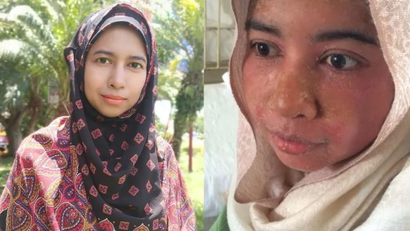 Bergelut dengan penyakit kulit yang teruk, wanita Malaysia ini kuatkan tekad genggam ijazah sarjana sambil besarkan empat anak Bergelut dengan penyakit kulit yang teruk, wanita Malaysia ini kuatkan tekad genggam ijazah sarjana sambil besarkan empat anak