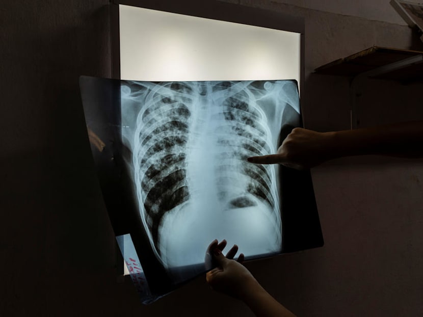 Covid-19 could affect TB control measures. This is what Singapore can do