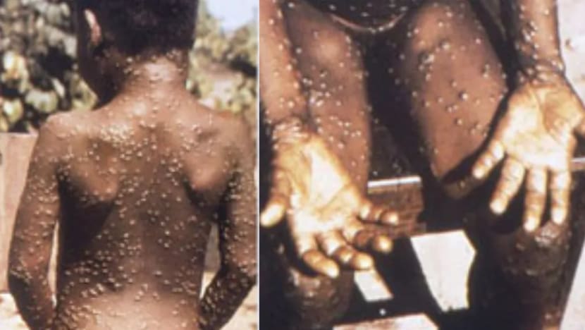 Why wiping out smallpox has stoked risk of monkeypox