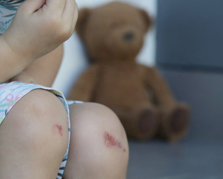Mother lodged report thinking 3-year-old daughter got bruises from pre-school, but maid was behind pinches
