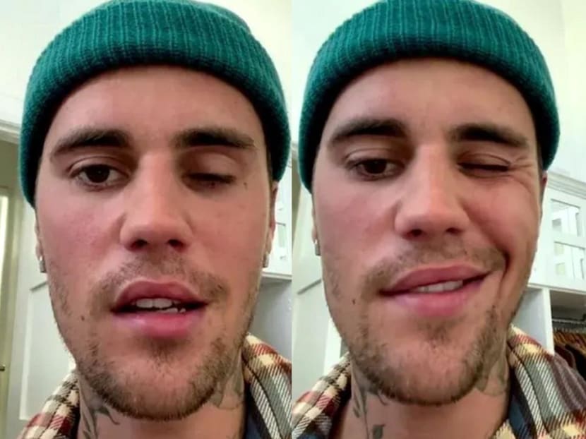 What’s the link between chickenpox and Justin Bieber’s facial paralysis? Are you at risk? What’s the link between chickenpox and Justin Bieber’s facial paralysis? Are you at risk?