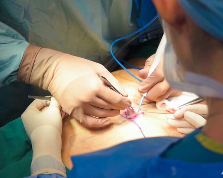 MOH says 'stern action' for doctors who perform liposuction without accreditation, doctor urges tighter guidelines