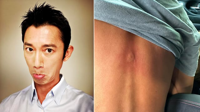 吴慷仁拍戏遭虎头蜂螫咬