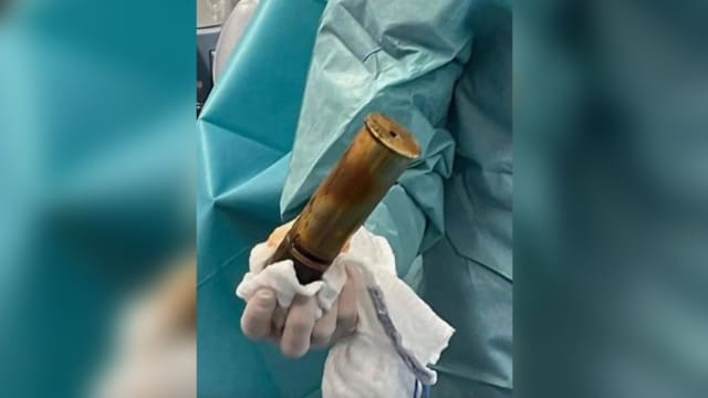 法国老翁直肠塞一战时期炮弹 医院紧急疏散病人