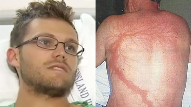 遭雷劈中大难不死 澳洲男子：闻到肉焦味