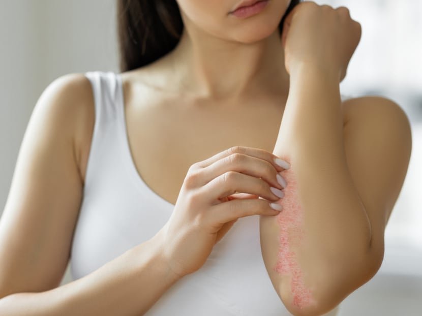 How can you tell if your itchy rash is psoriasis and not eczema? What are the treatments available?
