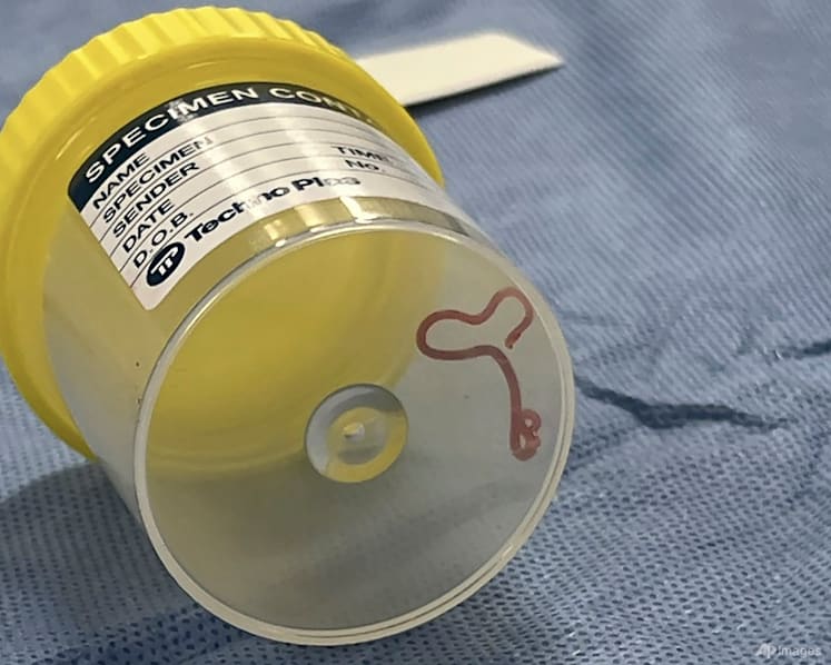 Commentary: Brain worms are rare - but other forms of parasitic infection are common