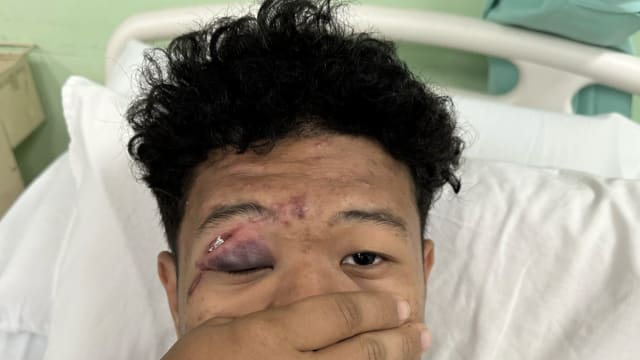 马国少年班上抽电子烟 老师竟用藤条打到眼睛险盲