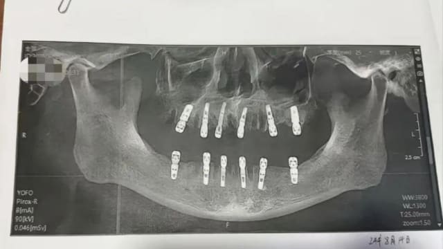 同一天拔牙23颗种牙12颗  浙江男子13天后去世