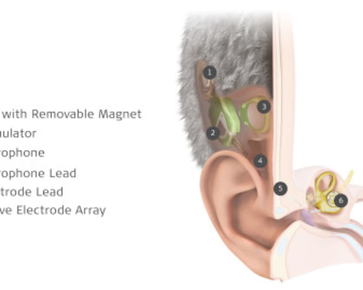 MED-EL Launches World’s First Commercially Available  Totally Invisible Cochlear Implant