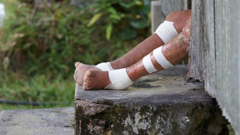 Terungkap, WNI terjangkit kusta di Rumania ternyata tertular dari Ibu di Bali