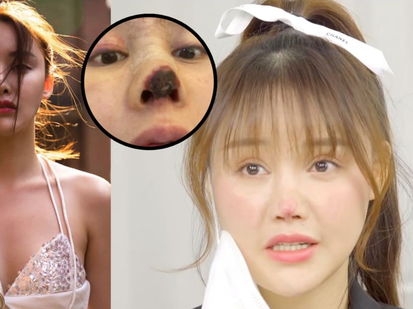 She opened up about her ordeal recently to warn others not to go to unlicensed aesthetic doctors.