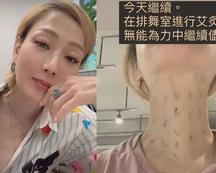 Sammi Cheng shares picture of neck after TCM therapy, says she’s “willing to eat toads” to regain her voice