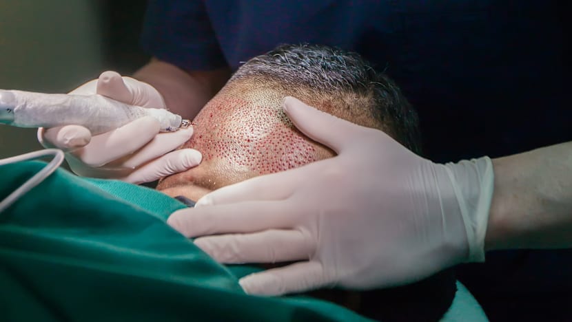 More men with hair loss opting for ‘that Wayne Rooney thing’