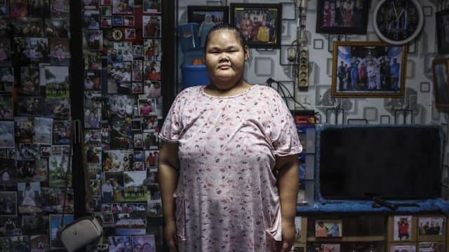 印尼儿童肥胖问题恶化 超越营养不良情况