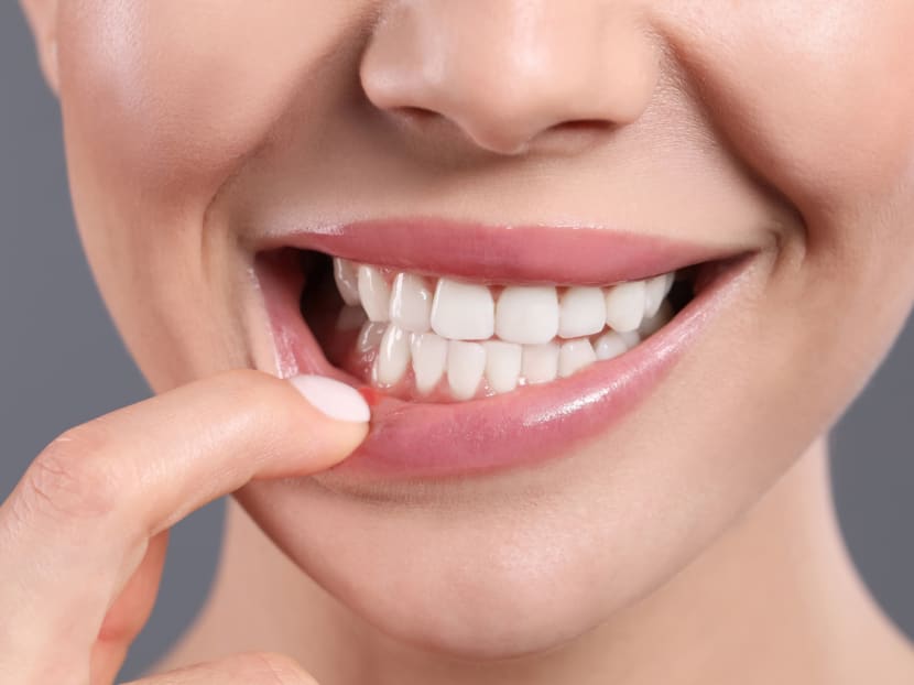 Does rubbing salt on mouth ulcers work? What you need to know about treating canker sores Does rubbing salt on mouth ulcers work? What you need to know about treating canker sores