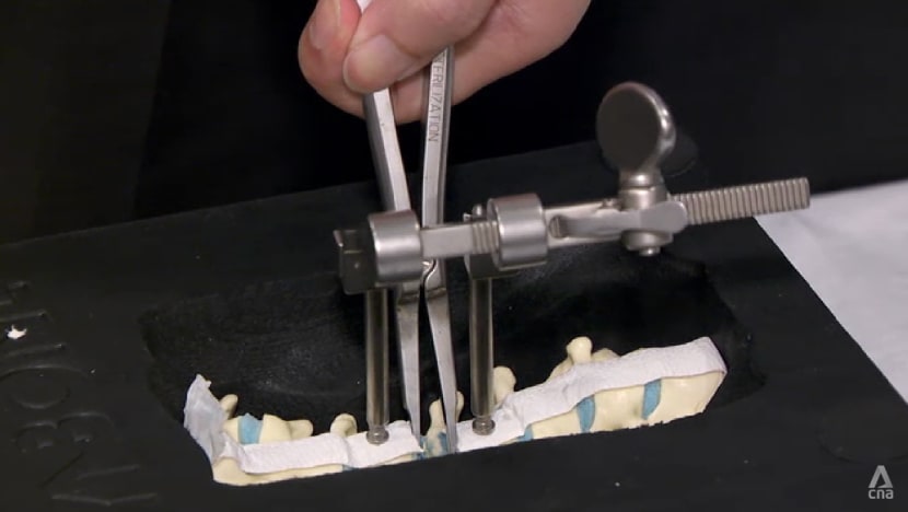 Singapore doctors develop new spinal surgery technique that reduces pain, improves mobility Singapore doctors develop new spinal surgery technique that reduces pain, improves mobility